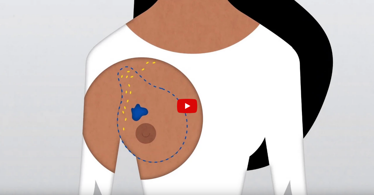 How Do Doctors Diagnose and Treat Breast Cancer?